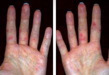 Koksaki virüsü nedeniyle bazı Rus turistler Antalya’dan erken ayrıldı