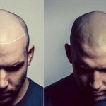 Sağlık turizmine ivme kazandıran saç dövmesi sektörü yaygınlaşıyor