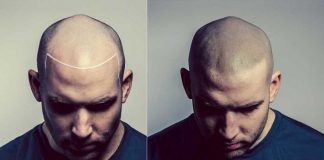 Sağlık turizmine ivme kazandıran saç dövmesi sektörü yaygınlaşıyor