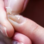 Tırnak Hastalıkları: Bu Belirtiler Ciddi Hastalıkların Habercisi Olabilir! Tırnak hastalıkları