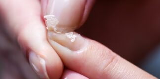 Tırnak Hastalıkları: Bu Belirtiler Ciddi Hastalıkların Habercisi Olabilir! Tırnak hastalıkları