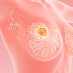 Meme Kanseri Hakkında En Çok Merak Edilen Sorular meme kanseri