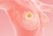 Meme Kanseri Hakkında En Çok Merak Edilen Sorular meme kanseri