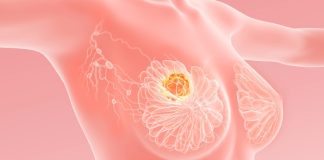 Meme Kanseri Hakkında En Çok Merak Edilen Sorular meme kanseri