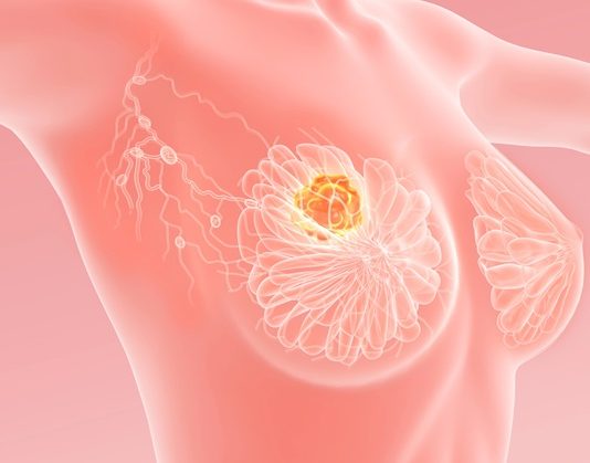 Meme Kanseri Hakkında En Çok Merak Edilen Sorular meme kanseri